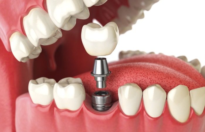 Dental Implant